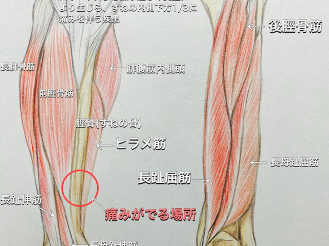 スネの痛み”シンスプリント”について