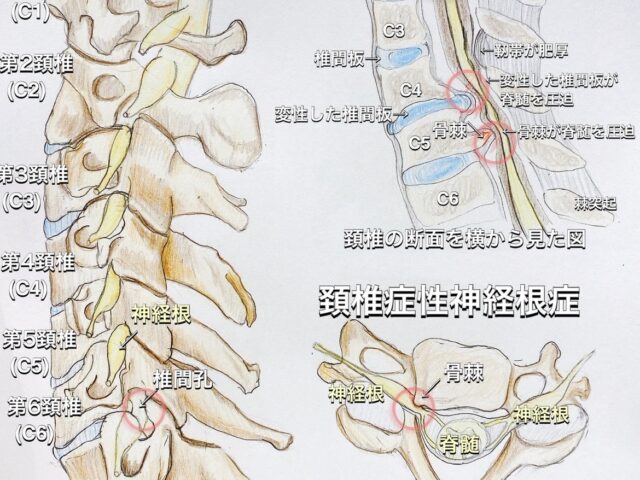 頚椎症とは！？