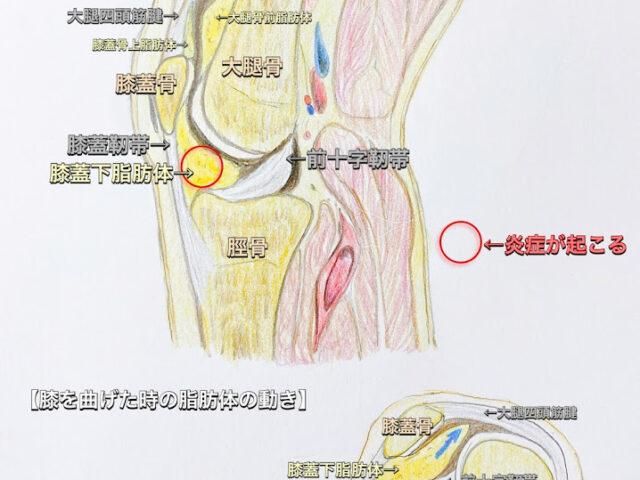 ✍🏻膝蓋下脂肪体炎（フォッファー病・Hoffa病）とは？