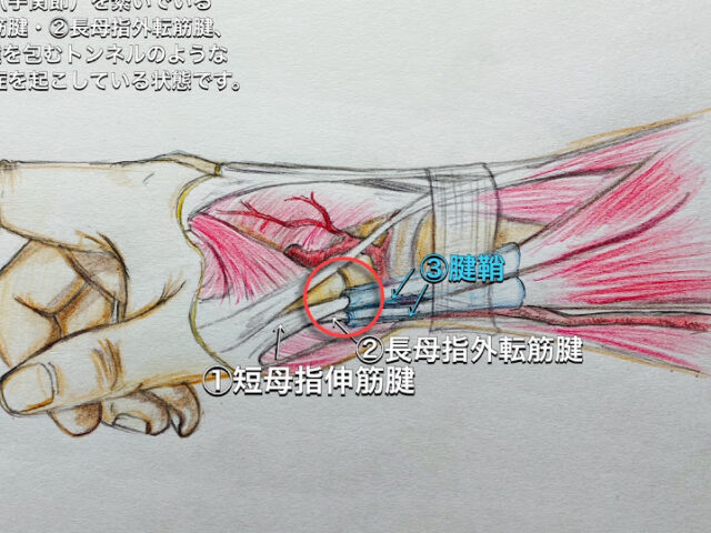 ドケルバン病とは！？