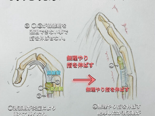 ばね指について